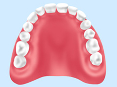 レジン床義歯 